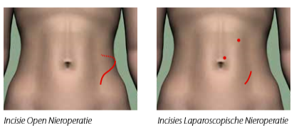 operatie nier verwijderen